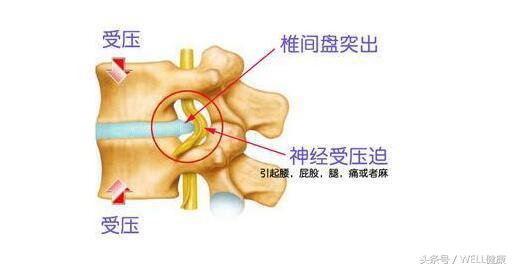 备孕腰椎间盘突出怎么办,腰椎间盘突出可以备孕吗