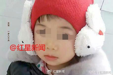 1岁女童被2000度开水烫伤后续,2岁女儿被开水烫伤完整版