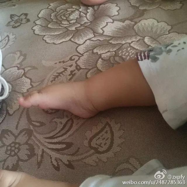 宝宝肌张力高怎么康复训练,宝宝肌张力有点高怎么做康复训练