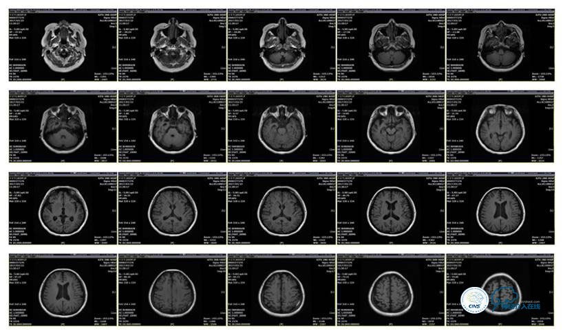 脑静脉窦狭窄做支架危险吗,静脉窦狭窄做支架后多久恢复