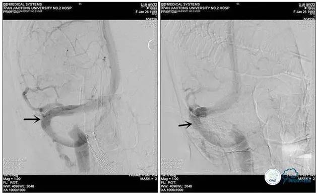 脑静脉窦狭窄做支架危险吗,静脉窦狭窄做支架后多久恢复