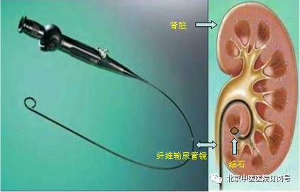 结石疼死了半夜发作怎么办,输尿管结石疼痛一招搞定