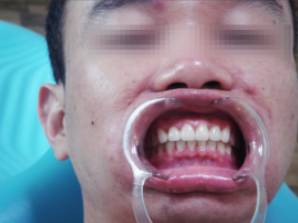 牙齿矫正特惠价3980,牙齿矫正特惠0元体验免费报名