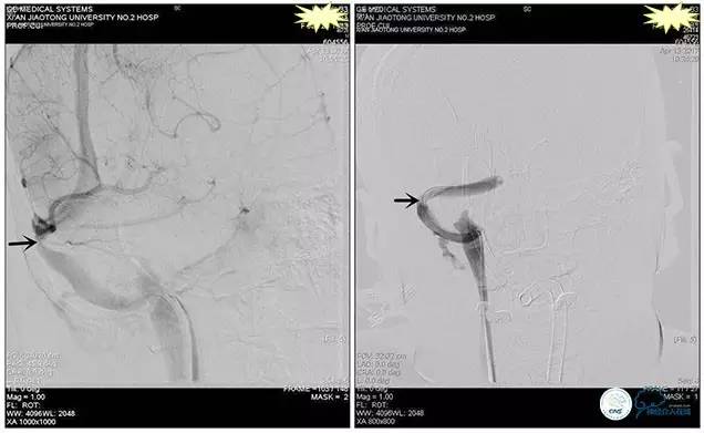脑静脉窦狭窄做支架危险吗,静脉窦狭窄做支架后多久恢复
