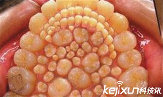 男孩嘴里有526颗牙,男孩多牙症300颗牙齿