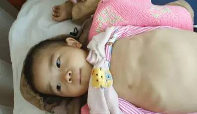 地中海贫血基因突变有影响吗,地中海贫血基因发生致病突变