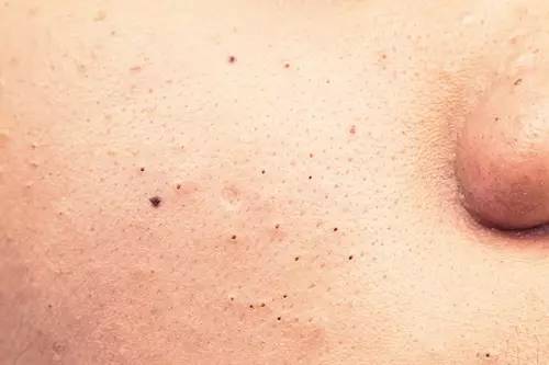 十年战痘血泪史详解,战痘知识分享