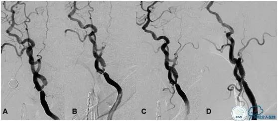 高龄颈动脉狭窄治疗,颈动脉高灌注综合征