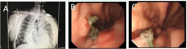 内镜荷包式缝合法视频,内镜下吻合口狭窄切开术