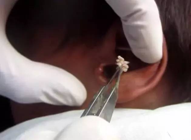 4岁男孩把黄豆塞进耳朵,小男孩把豆子塞耳朵里了