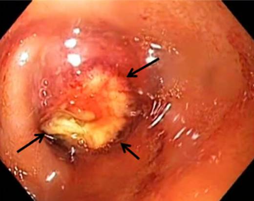 内镜下肌切开术手术步骤,肌肉活检最新技术