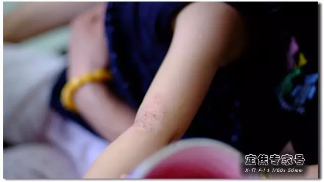 「热点」越是古老的疾病坑越多,一个湿疹能有多少坑把父母掉进去?