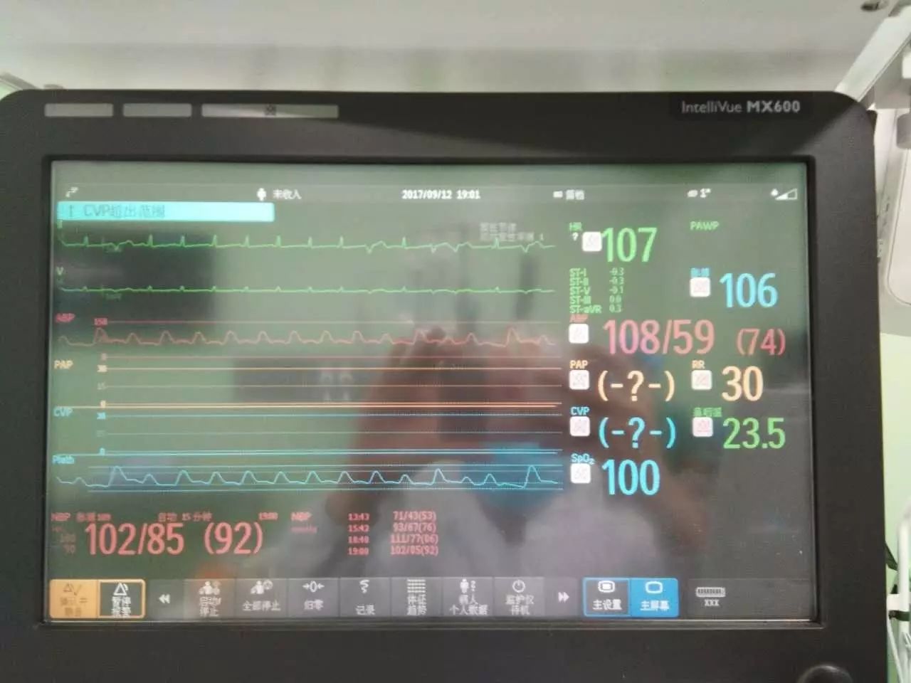 腰椎间盘突出微创案例,20年前的腰椎间盘微创手术