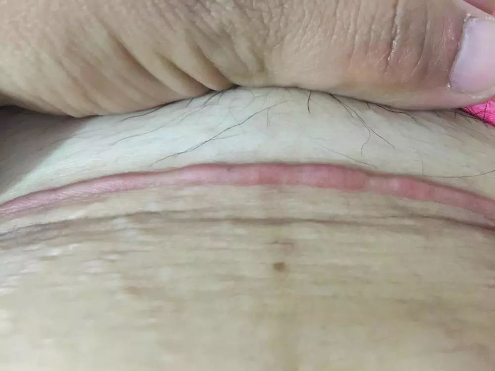 产妇刀口痒是怎么回事,产后刀口增生的原因和治疗方法