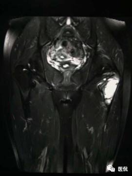 髋部疼痛做什么检查,左髋部疼痛待查病例