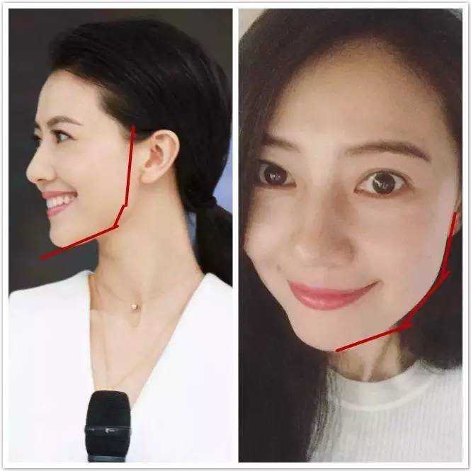 重度下垂的脸怎么恢复,已经下垂的脸还可以拯救吗