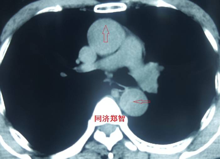 急性主动脉夹层cta影像诊断与鉴别,冠状动脉cta可以看到主动脉夹层吗
