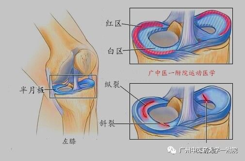 养生堂半月板损伤怎样修复,半月板损伤针灸还是封闭治疗好
