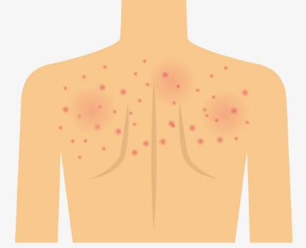 顶尖银屑病专家,10月28号世界银屑病日健康讲座
