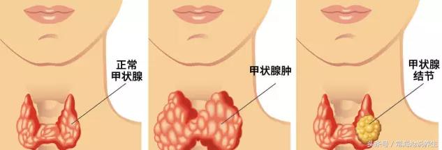 甲状腺结节癌的早期症状有哪些,恶性甲状腺结节2厘米是早期吗