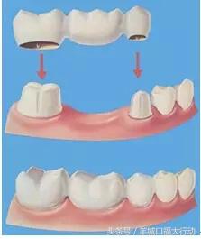 拔牙后镶牙的最佳时间,拔牙后镶牙最佳时间表