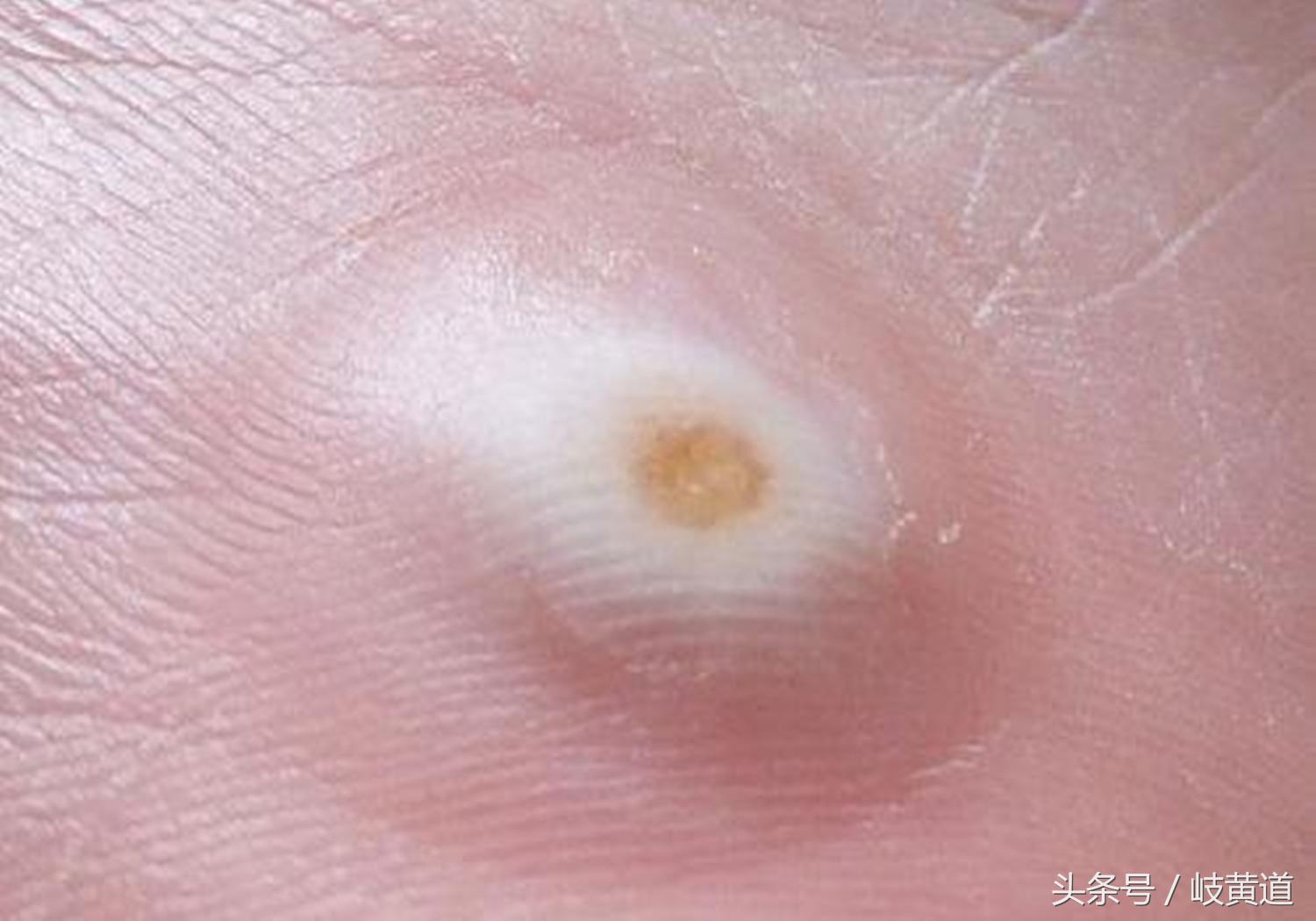 鸡眼总是不好怎么办,中医鸡眼是怎么回事