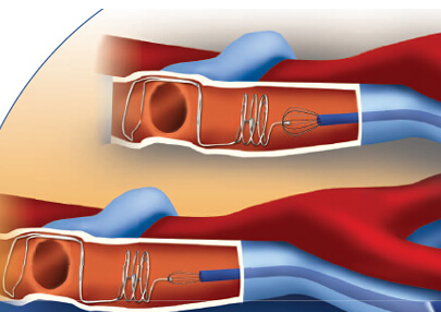 治疗下肢深静脉血栓最好的医院,下肢深静脉血栓腿肿为啥恢复慢