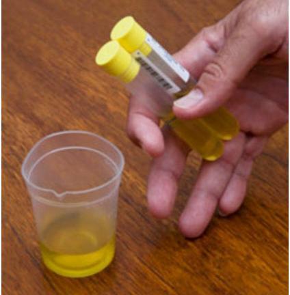 怀孕尿检什么指标,尿检指标科学解读