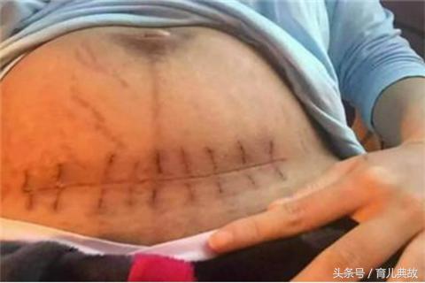剖腹产后疤痕恢复情况变化,剖腹产疤痕恢复好了怎么有个坑