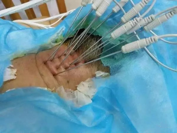 射频消融术和内热针有什么区别,内热针疗法治疗腰间盘突出