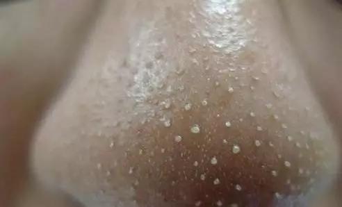 鼻子上挤出的白色条状物到底是啥,鼻子两边能挤出白色东西的是什么