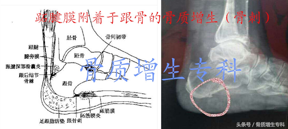 脚跟骨质增生,最全解析(含锻炼方法和防、治)