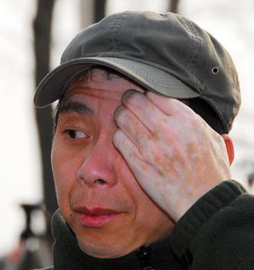 白癜风治疗为什么这么贵,白癜风长的哪个部位最难治