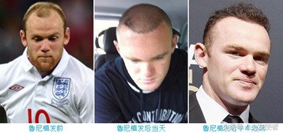 脱发五年多久能治好脱发,脱发如何治疗的视频