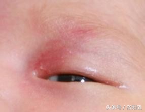 激光祛鲜红斑痣,鲜红斑痣综合征