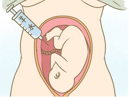 唐筛21高危做无创dna还是羊水穿刺,唐筛高危医生建议做羊膜穿刺