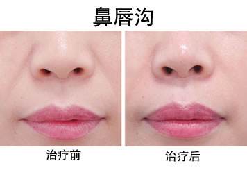 娱乐圈不老小妖精们的诀窍，玻尿酸的一二事儿~