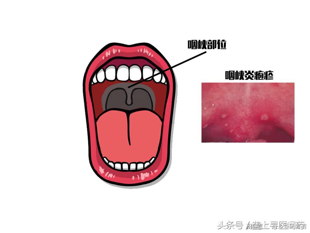 疱疹性咽峡炎高烧不退是怎么回事,宝宝高烧不退一定要小心这种病