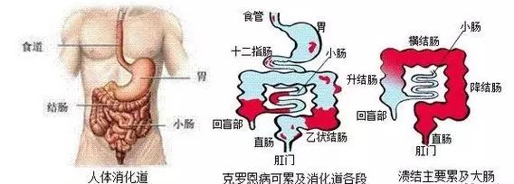治愈溃疡性结肠炎的民间中医高手,河南治疗溃疡性结肠炎中医
