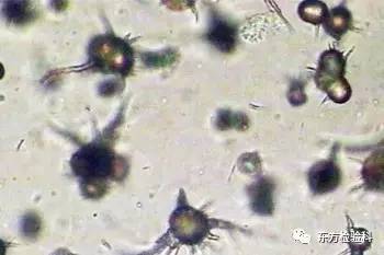 孕妇尿结晶数值多少是结石,尿结晶数量高看什么科