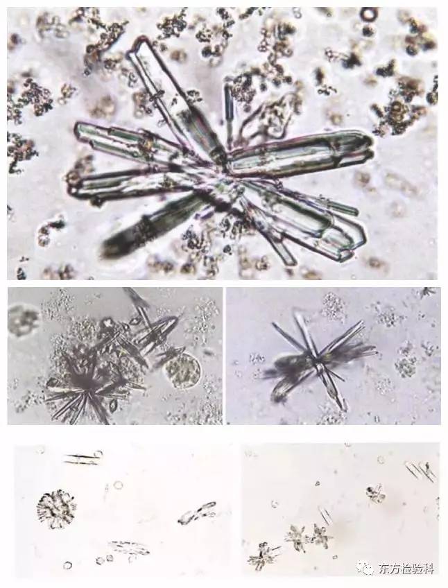 孕妇尿结晶数值多少是结石,尿结晶数量高看什么科