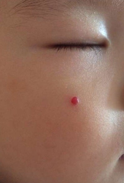 小孩脸被同学抓伤流血,孩子脸用铅笔扎了会留疤吗