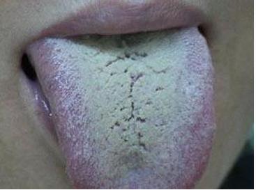 舌苔很重口苦口臭是怎么回事,舌苔厚口臭口苦是什么病