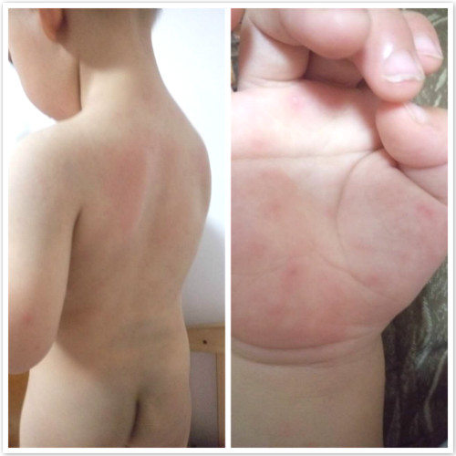 2岁宝宝老是得咽峡炎疱疹,得了疱疹性咽峡炎还会有手足口吗