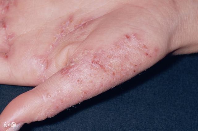 皮炎性湿疹饮食注意事项,过敏性皮炎湿疹饮食上要注意什么