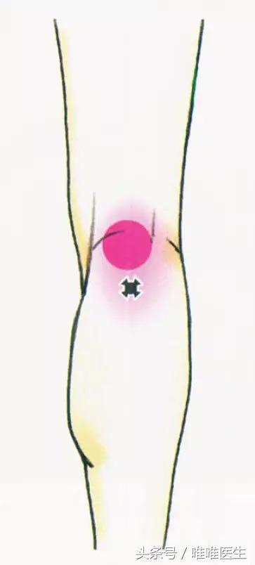 膝盖疼痛治疗经验分享,膝关节总结