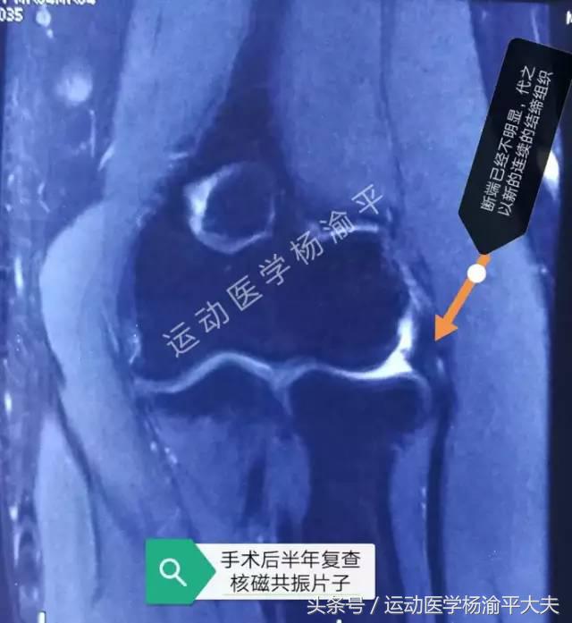 做完小针刀打封闭,做了一次小针刀怎么补救