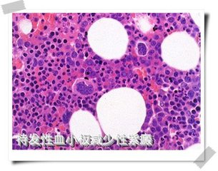 乏力、双下肢不痛痒的“出血点”，竟是“累出来”的“血液病”？