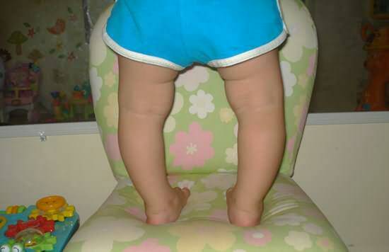 外旋型o型腿哪种矫正方式最有效,宝宝为什么会o型腿