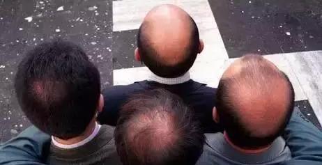 治疗脱发一般需要多少毛囊,脱发时毛囊也掉了怎么回事